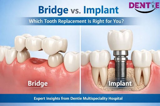 Bridge vs Implant: The Ultimate Guide For Tooth Replacement Choices