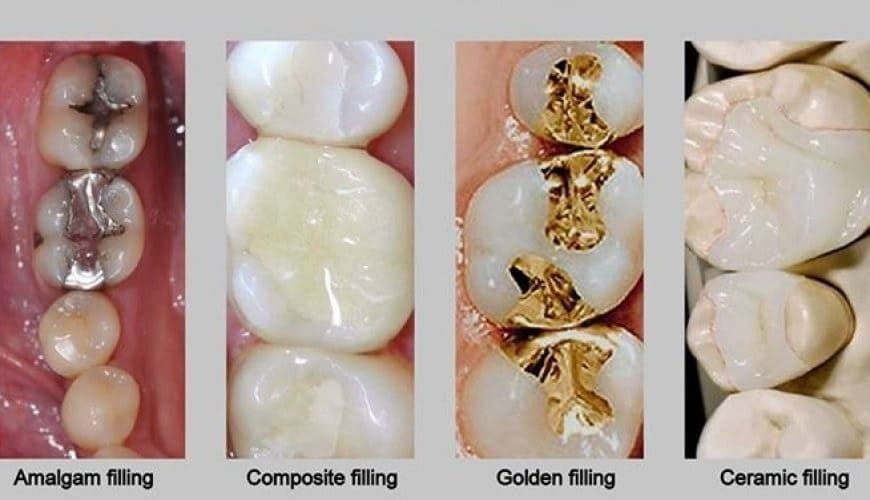 Dental Fillings Image