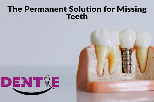 The Ultimate Upgrade: Why Dental Implants Are the Permanent Solution for Missing Teeth