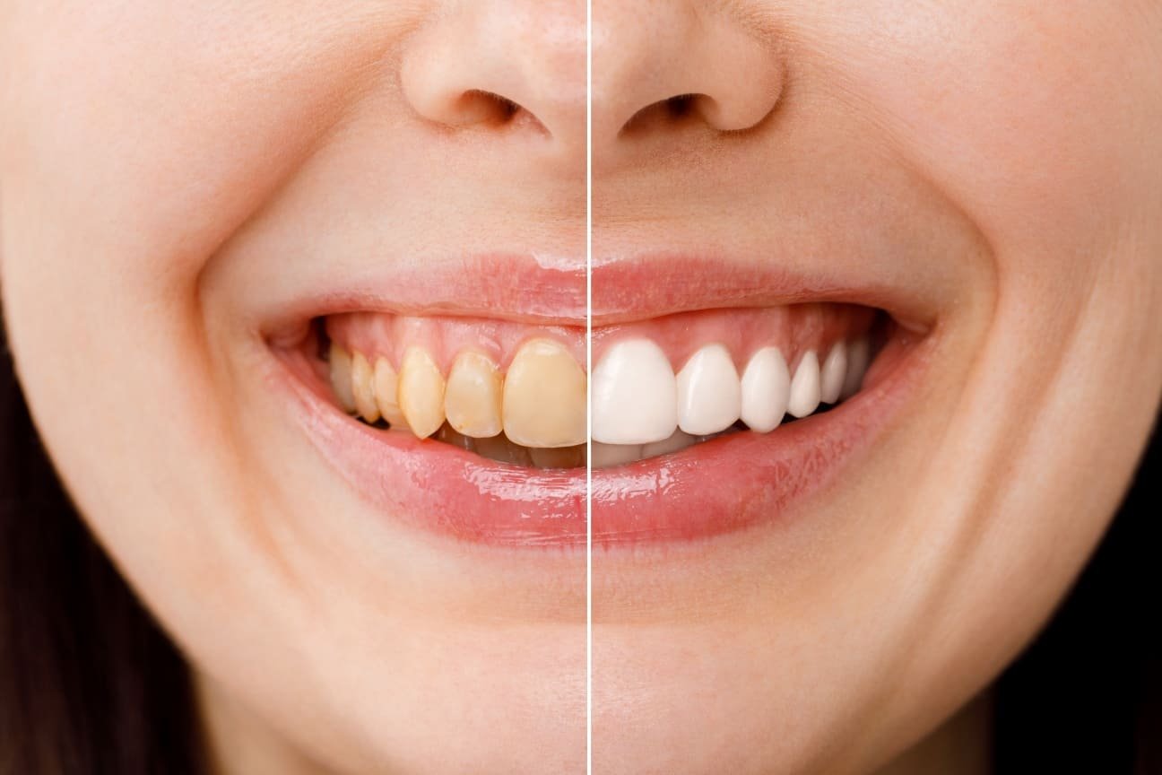 Teeth Whitening Image